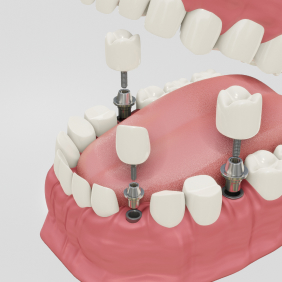 implante dentário